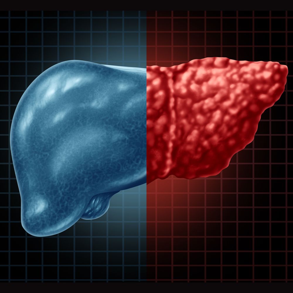 Doença hepática gordurosa não alcoólica