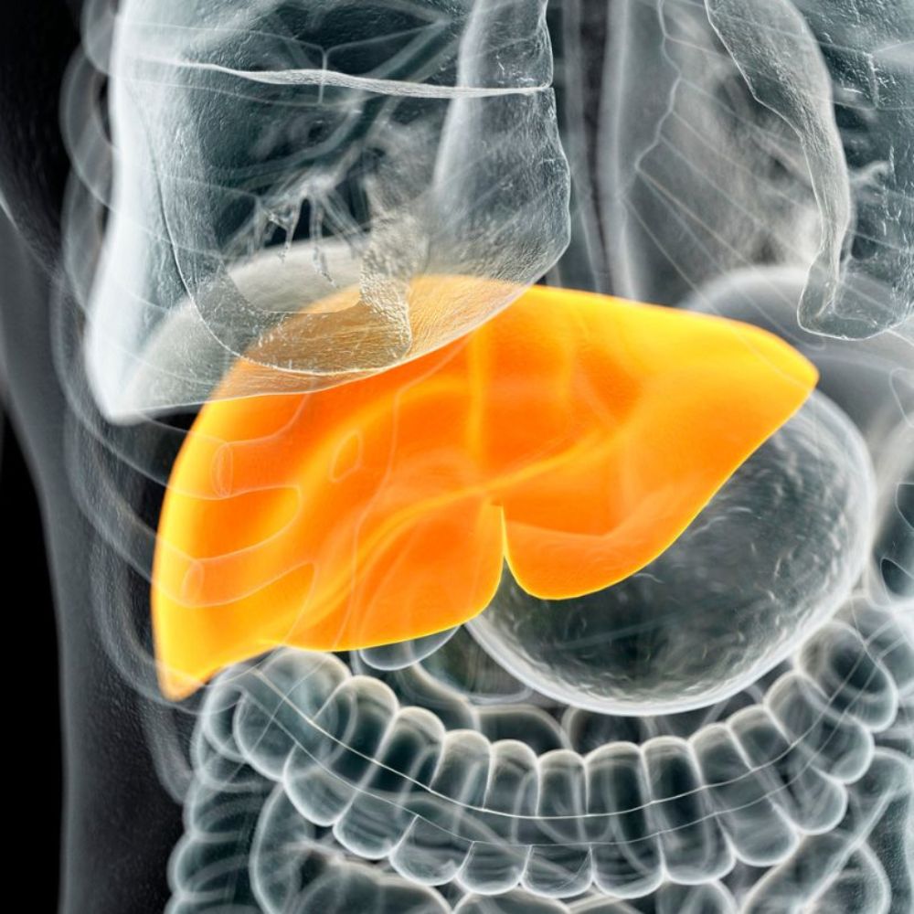 Doença hepática gordurosa alcoólica