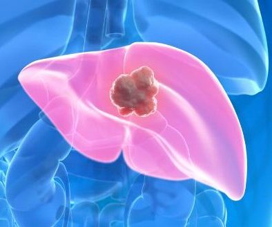 Tumores benignos do fígado